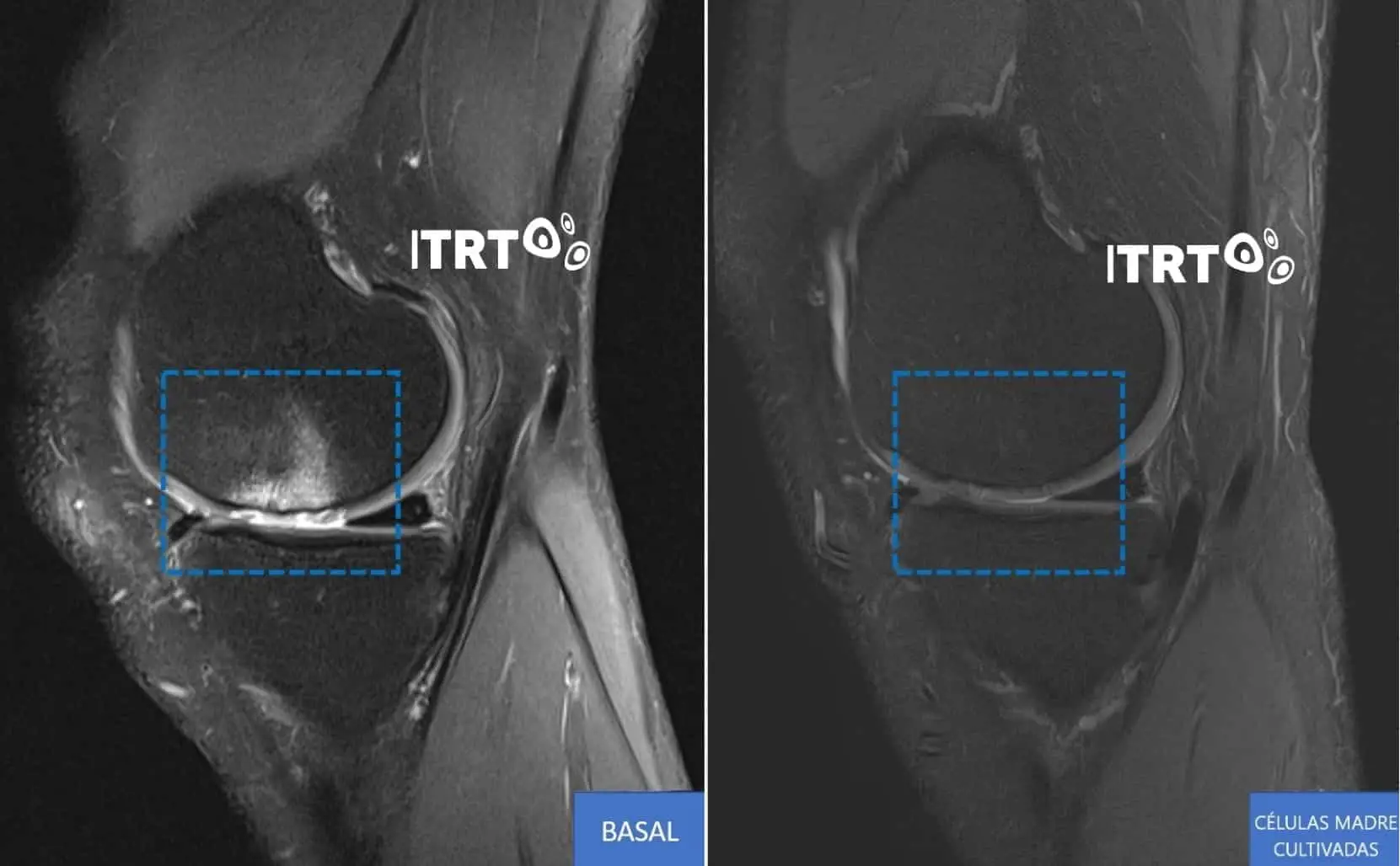 ¿es la cirugía la única opción ante una artrosis de rodilla?