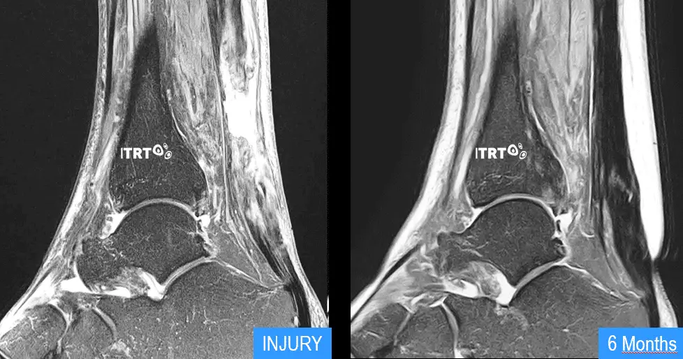 Tendinopathy treatment with Cultured Stem Cells