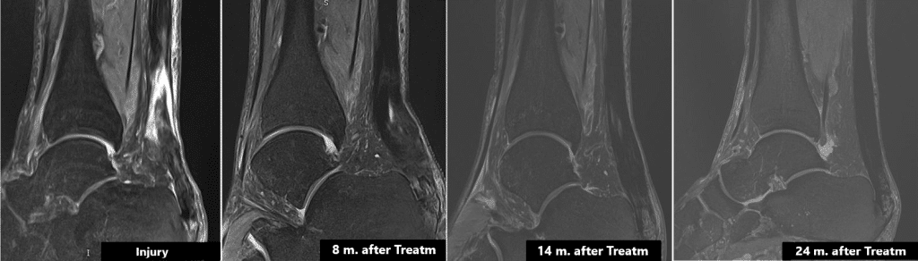 Achilles Tendon rupture 2 Tendinopathy treatment