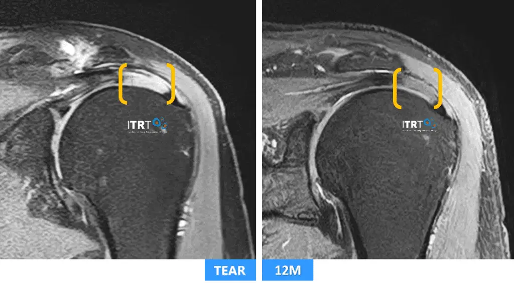 Rotator cuff tear and regeneration with cultured stem cells