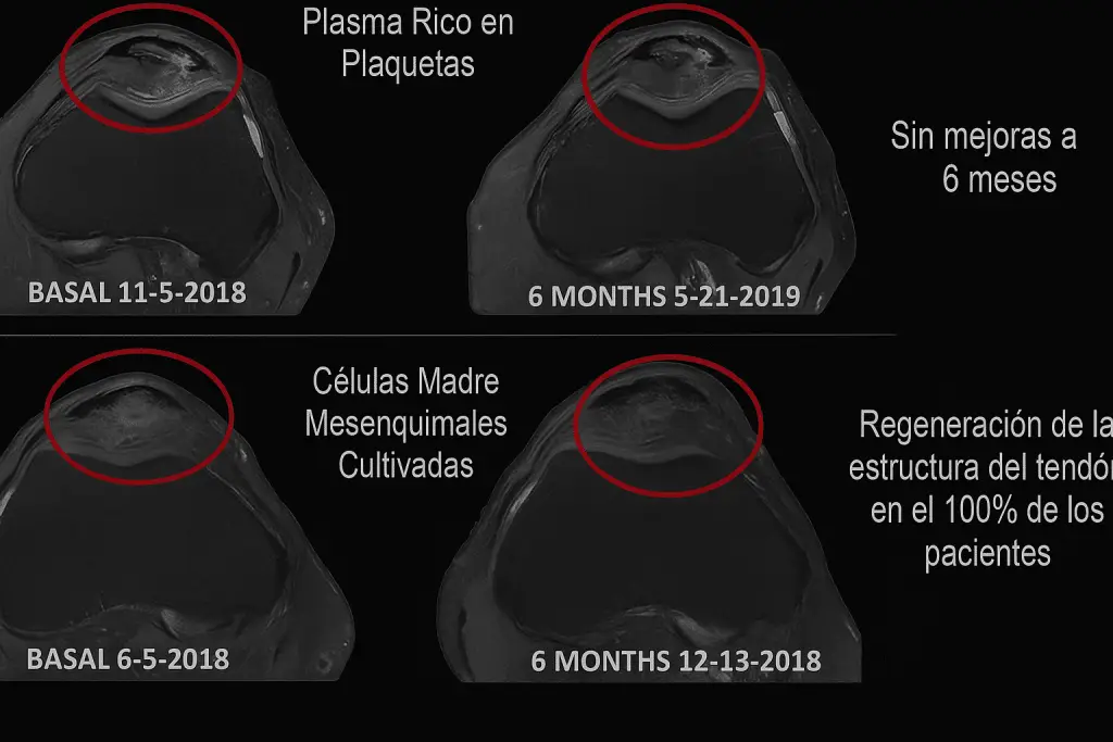 regenerar tendón con células mesenquimales
