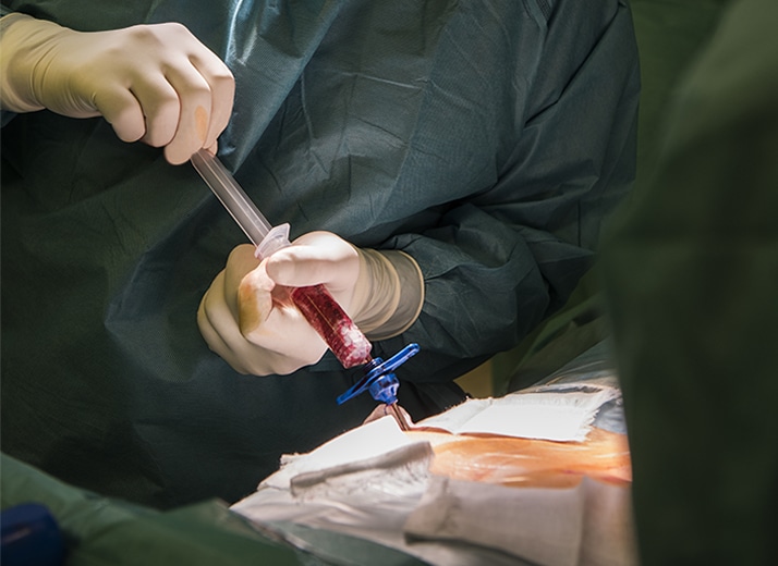 Pseudoartrosis: síntomas, diagnóstico precoz y terapias avanzadas con células mesenquimales cultivadas 1 Aspiración de médula ósea para obtener células mesenquimales en el proceso de fabricación de medicamentos celulares en ITRT