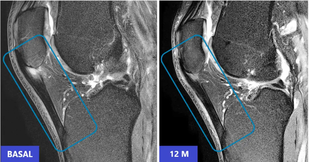 MRI of patellar tendon with fiber tear before treatment with cultured mesenchymal cells (CMC) at ITRT