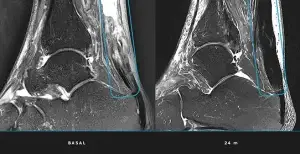 Can an achilles tendon injury be regenerated?