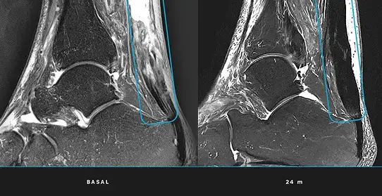 Can an achilles tendon injury be regenerated?