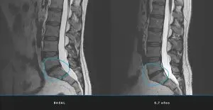 Lumbar MRI comparing the intervertebral disc at baseline and at 6.7 years after treatment with CMC, with visible structural improvement at the marked level