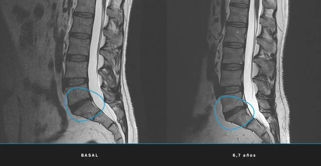 Hernia discal sin compresión nerviosa: ¿existe un tratamiento que regenere estructuralmente el disco intervertebral? 2 Resonancia magnética lumbar comparando el disco intervertebral en el momento basal y a los 6,7 años tras el tratamiento con CMC, con mejora estructural visible en el nivel señalado
